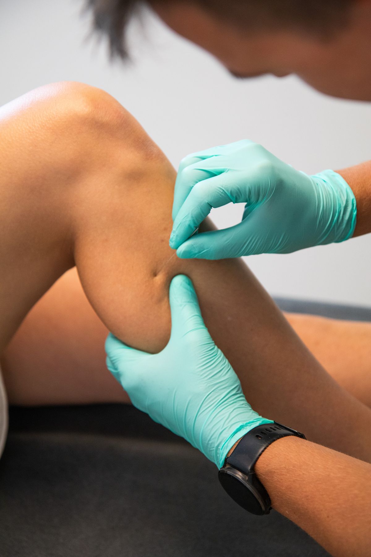 Dry needling